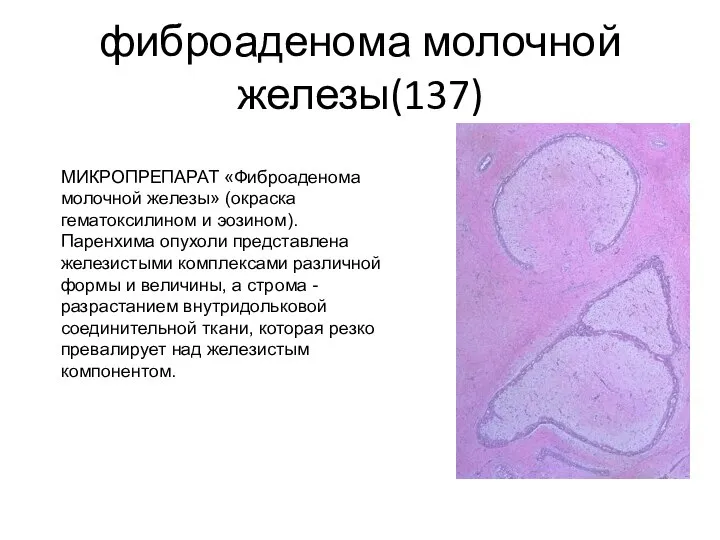 фиброаденома молочной железы(137) МИКРОПРЕПАРАТ «Фиброаденома молочной железы» (окраска гематоксилином и эозином). Паренхима