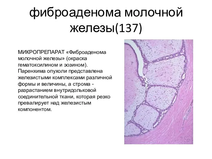 фиброаденома молочной железы(137) МИКРОПРЕПАРАТ «Фиброаденома молочной железы» (окраска гематоксилином и эозином). Паренхима