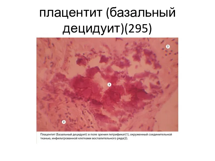 плацентит (базальный децидуит)(295)