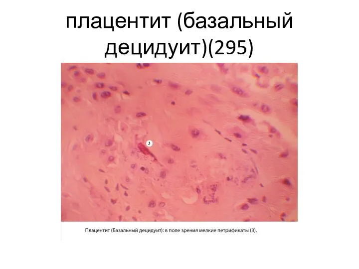плацентит (базальный децидуит)(295)