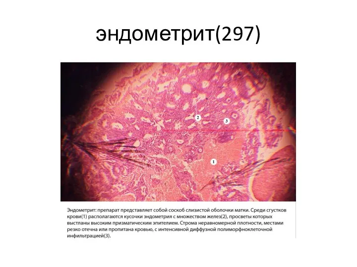 эндометрит(297)