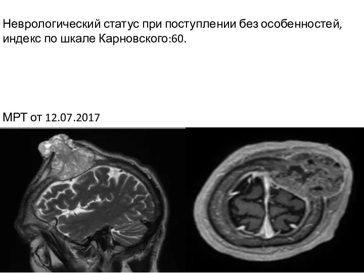 МРТ от 12.07.2017 Неврологический статус при поступлении без особенностей, индекс по шкале Карновского:60.