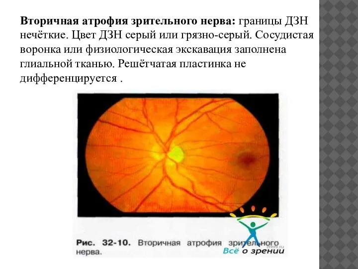 Вторичная атрофия зрительного нерва: границы ДЗН нечёткие. Цвет ДЗН серый или грязно-серый.