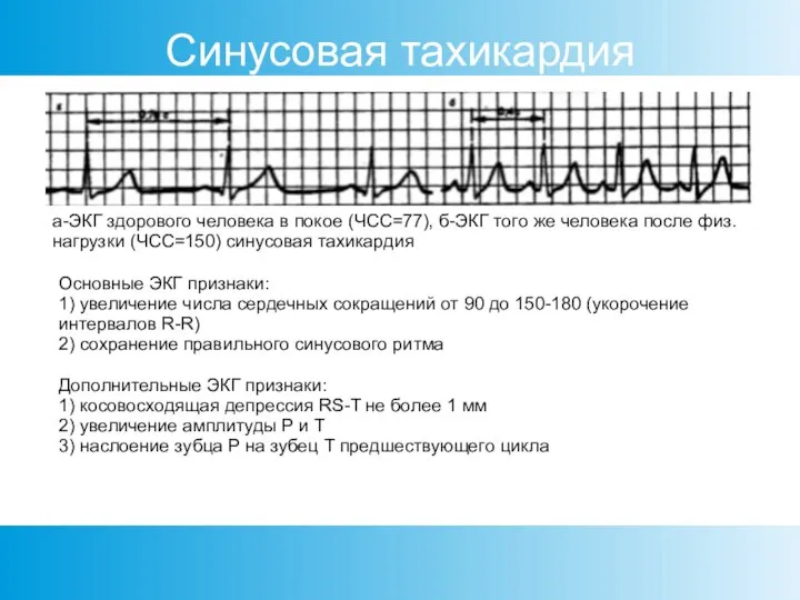 а-ЭКГ здорового человека в покое (ЧСС=77), б-ЭКГ того же человека после физ.нагрузки