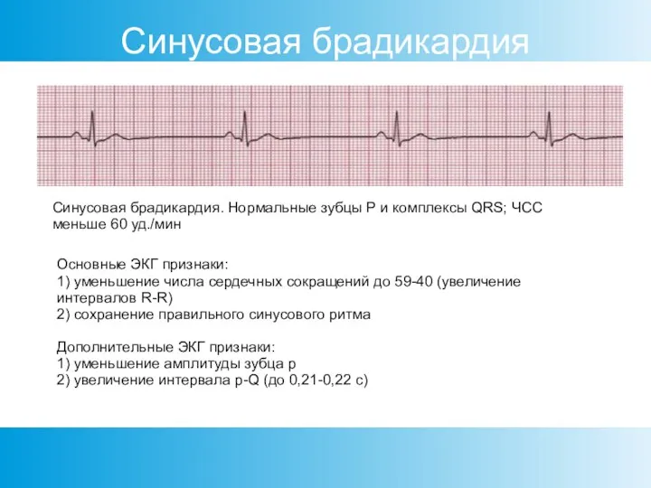 Синусовая брадикардия. Нормальные зубцы Р и комплексы QRS; ЧСС меньше 60 уд./мин