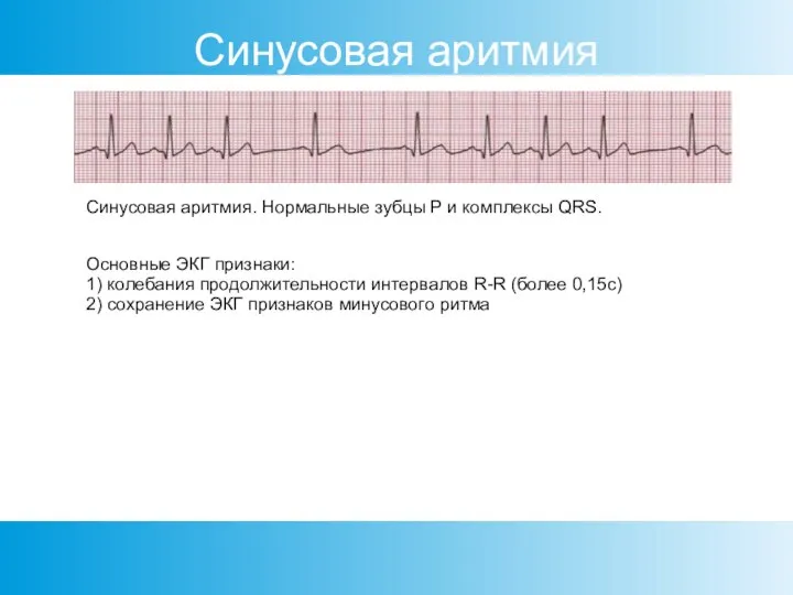 Синусовая аритмия Синусовая аритмия. Нормальные зубцы Р и комплексы QRS. Основные ЭКГ