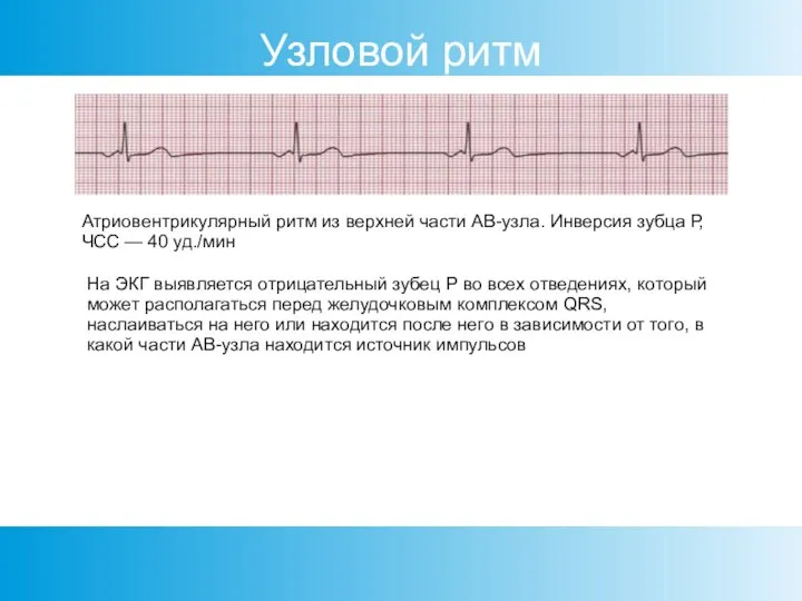 Узловой ритм Атриовентрикулярный ритм из верхней части АВ-узла. Инверсия зубца Р, ЧСС