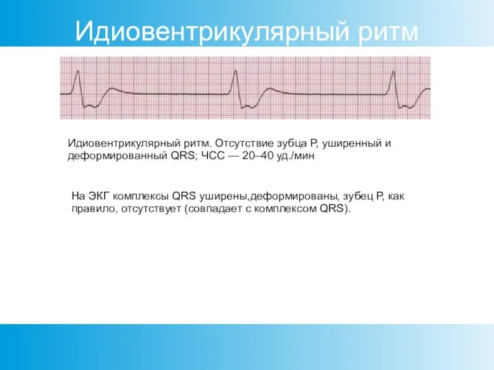 Идиовентрикулярный ритм Идиовентрикулярный ритм. Отсутствие зубца Р, уширенный и деформированный QRS; ЧСС