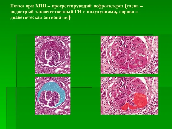 Почка при ХПН – прогрессирующий нефросклероз (слева – подострый злокачественный ГН с