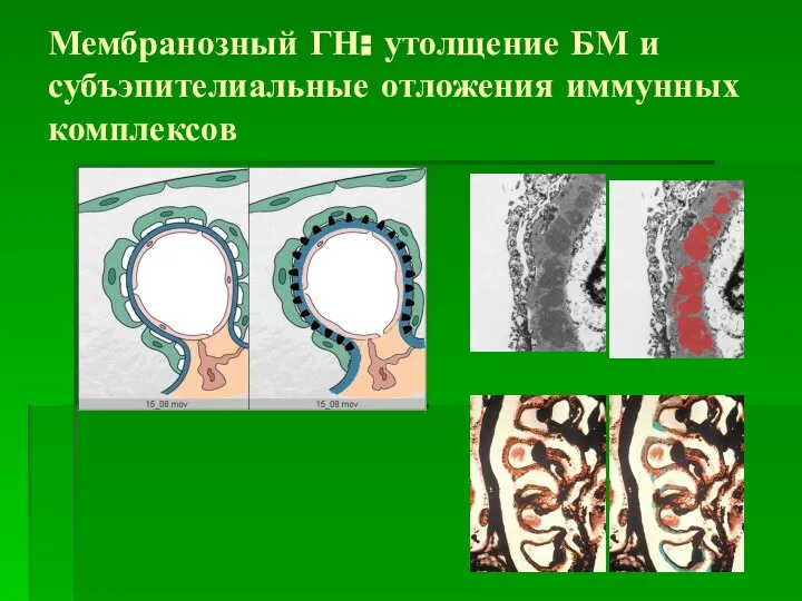 Мембранозный ГН: утолщение БМ и субъэпителиальные отложения иммунных комплексов