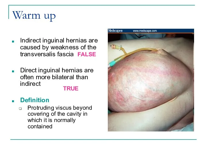 Warm up Indirect inguinal hernias are caused by weakness of the transversalis