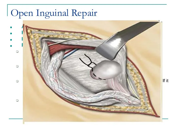 Open Inguinal Repair Anaesthesia – general, spinal, local Position - supine Incision