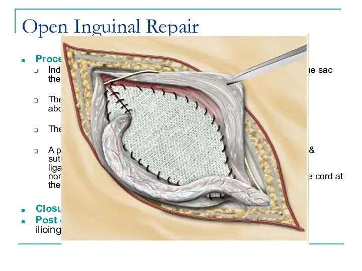 Open Inguinal Repair Procedure cont’ Indirect sac will be identified by separating
