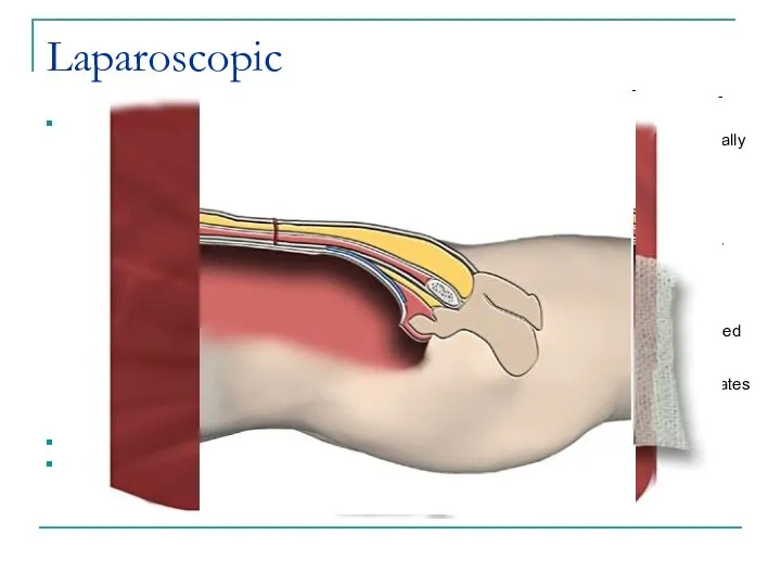 Laparoscopic Procedure The peritoneum is separated from the abdominal wall behind the