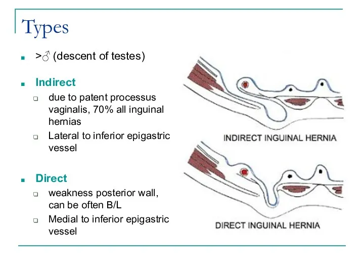 Types >♂ (descent of testes) Indirect due to patent processus vaginalis, 70%