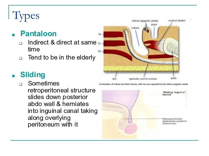 Types Pantaloon Indirect & direct at same time Tend to be in