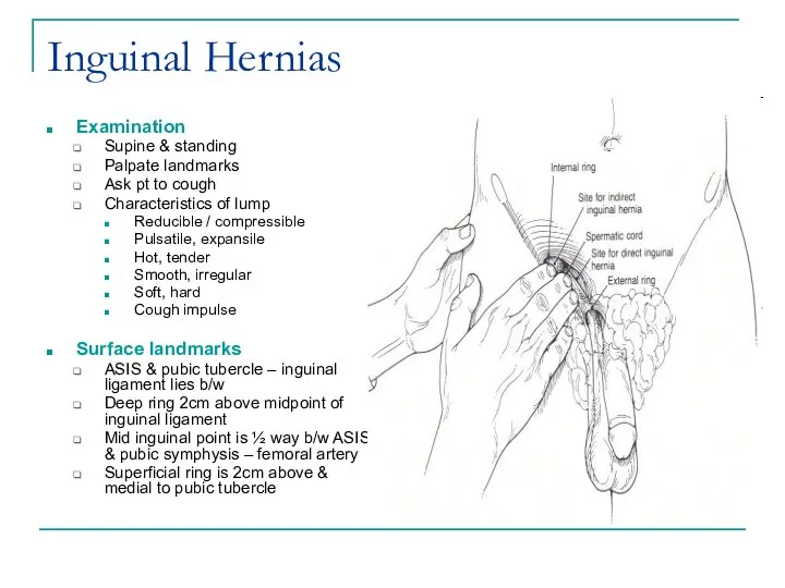 Inguinal Hernias Examination Supine & standing Palpate landmarks Ask pt to cough