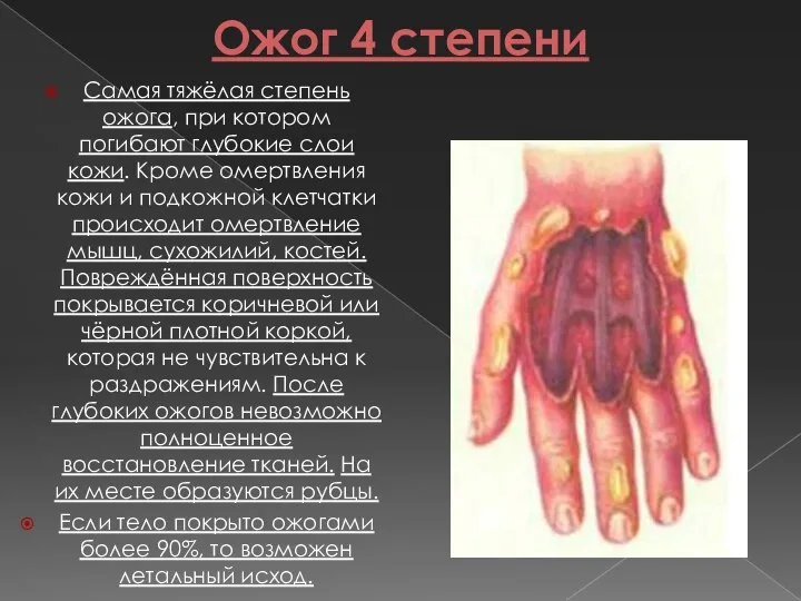 Ожог 4 степени Самая тяжёлая степень ожога, при котором погибают глубокие слои