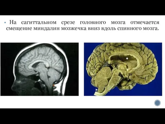 Ha сагиттальном срезе головного мозга отмечается смещение миндалин мозжечка вниз вдоль спинного мозга.
