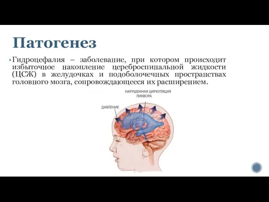 Патогенез Гидроцефалия – заболевание, при котором происходит избыточное накопление цереброспинальной жидкости (ЦСЖ)