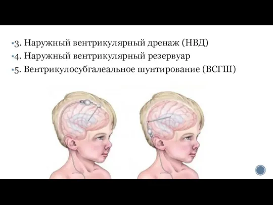 3. Наружный вентрикулярный дренаж (НВД) 4. Наружный вентрикулярный резервуар 5. Вентрикулосубгалеальное шунтирование (ВСГШ)