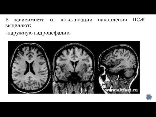 В зависимости от локализации накопления ЦСЖ выделяют: наружную гидроцефалию