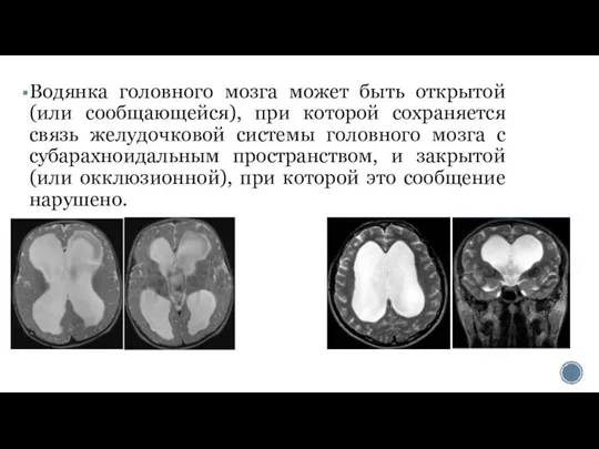 Водянка головного мозга может быть открытой (или сообщающейся), при которой сохраняется связь