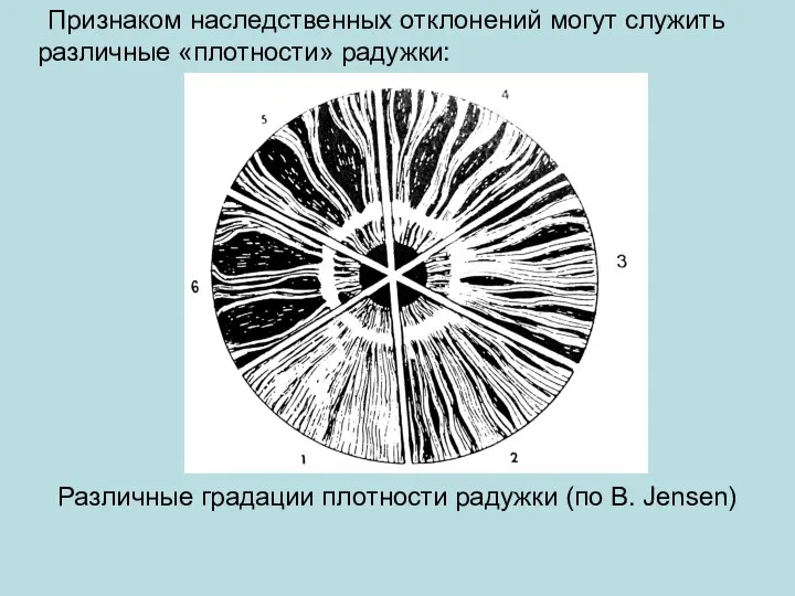 Признаком наследственных отклонений могут служить различные «плотности» радужки: Различные градации плотности радужки (по В. Jensen)