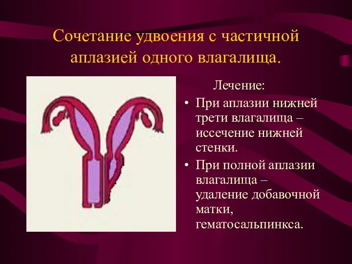 Сочетание удвоения с частичной аплазией одного влагалища. Лечение: При аплазии нижней трети