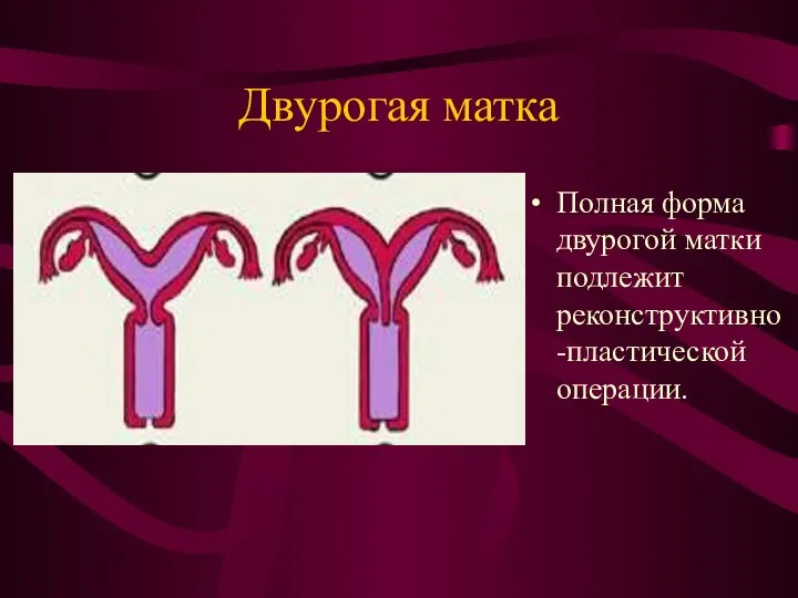 Двурогая матка Полная форма двурогой матки подлежит реконструктивно-пластической операции.