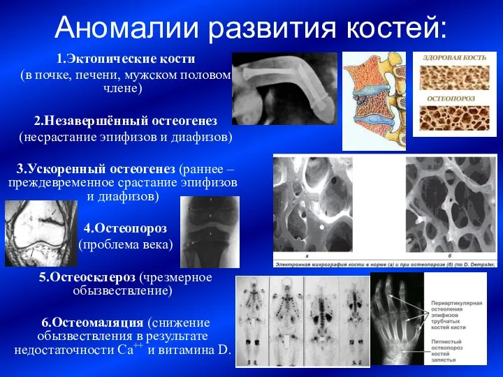 Аномалии развития костей: 1.Эктопические кости (в почке, печени, мужском половом члене) 2.Незавершённый