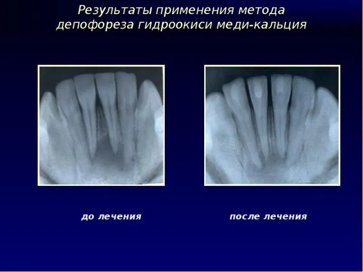 Депофорез – какие плюсы?