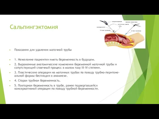 Сальпингэктомия Показания для удаления маточной трубы 1. Нежелание пациентки иметь беременность в