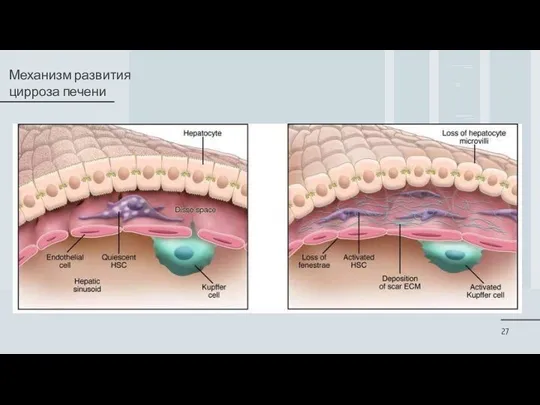 Механизм развития цирроза печени