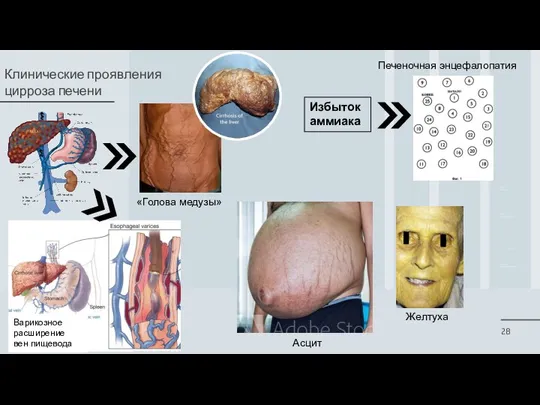 Клинические проявления цирроза печени «Голова медузы» Желтуха Асцит Варикозное расширение вен пищевода Печеночная энцефалопатия Избыток аммиака