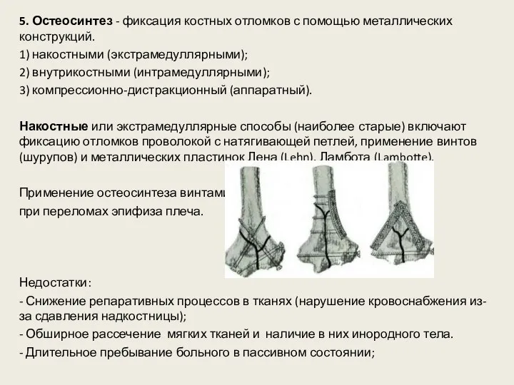 5. Остеосинтез - фиксация костных отломков с помощью металлических конструкций. 1) накостными