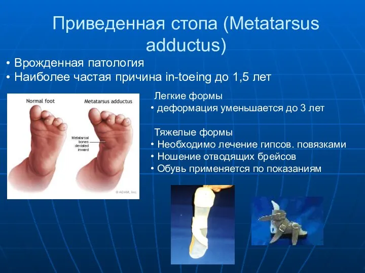 Приведенная стопа (Metatarsus adductus) Врожденная патология Наиболее частая причина in-toeing до 1,5