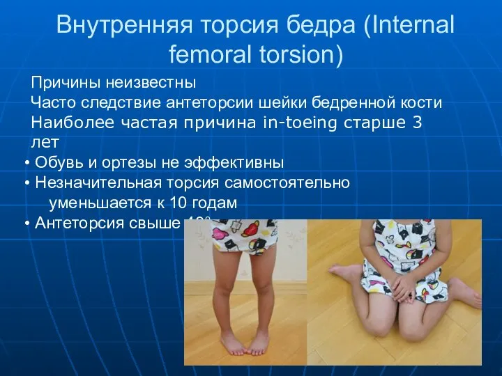 Внутренняя торсия бедра (Internal femoral torsion) Причины неизвестны Часто следствие антеторсии шейки
