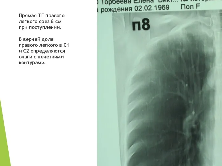Прямая ТГ правого легкого срез 8 см при поступлении. В верней доле