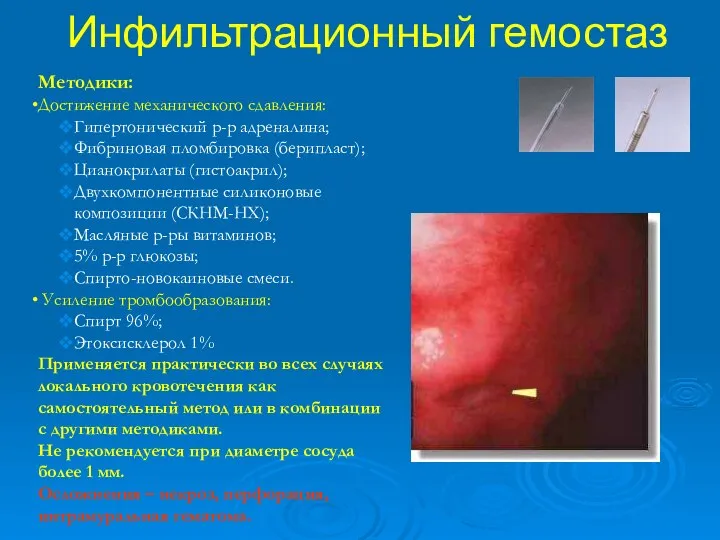 Инфильтрационный гемостаз Методики: Достижение механического сдавления: Гипертонический р-р адреналина; Фибриновая пломбировка (берипласт);