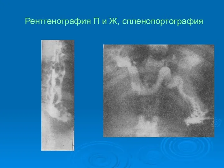 Рентгенография П и Ж, спленопортография