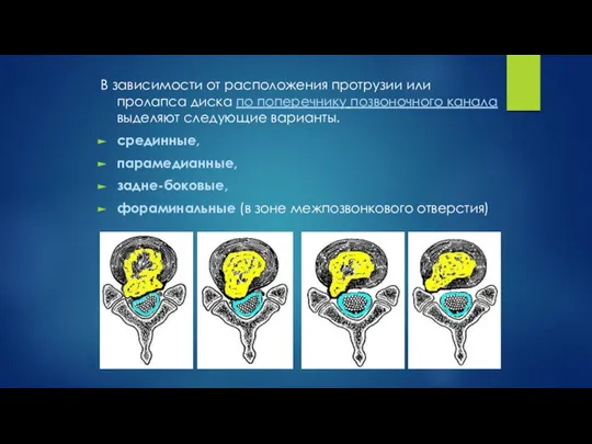 В зависимости от расположения протрузии или пролапса диска по поперечнику позвоночного канала