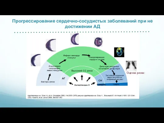 Прогрессирование сердечно-сосудистых заболеваний при не достижении АД Оценка риска: