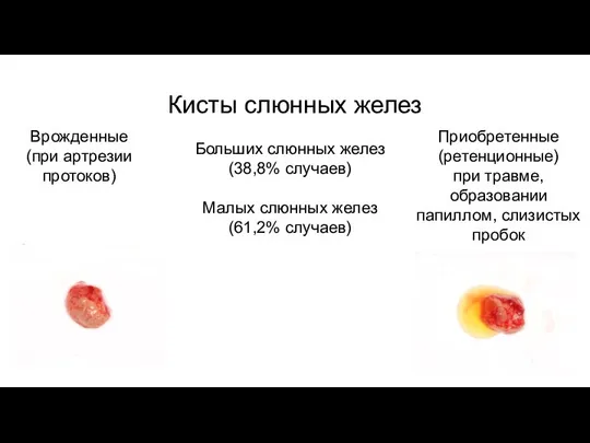 Кисты слюнных желез Врожденные (при артрезии протоков) Приобретенные (ретенционные) при травме, образовании