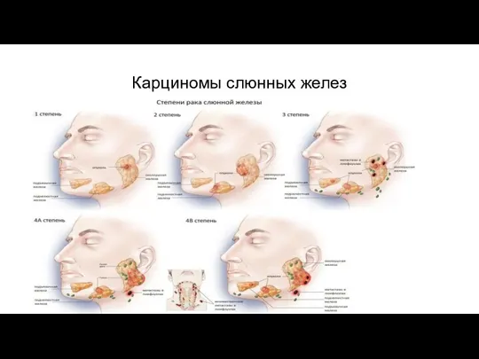 Карциномы слюнных желез