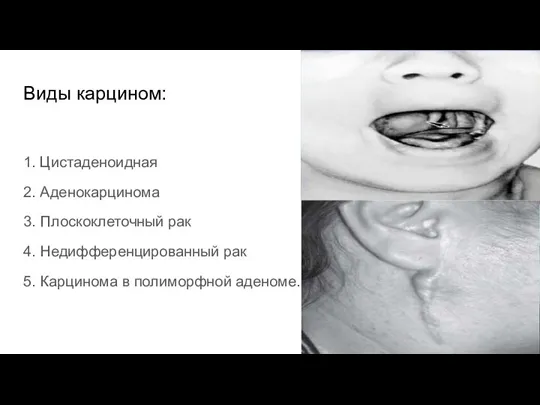 Виды карцином: 1. Цистаденоидная 2. Аденокарцинома 3. Плоскоклеточный рак 4. Недифференцированный рак