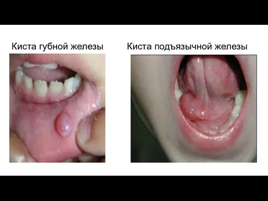 Киста губной железы Киста подъязычной железы