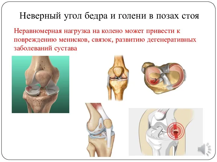 Неравномерная нагрузка на колено может привести к повреждению менисков, связок, развитию дегенеративных