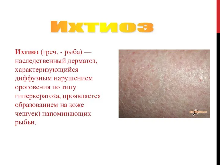 Ихтиоз (греч. - рыба) — наследственный дерматоз, характеризующийся диффузным нарушением ороговения по