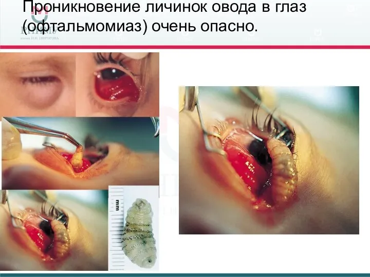 Проникновение личинок овода в глаз (офтальмомиаз) очень опасно.